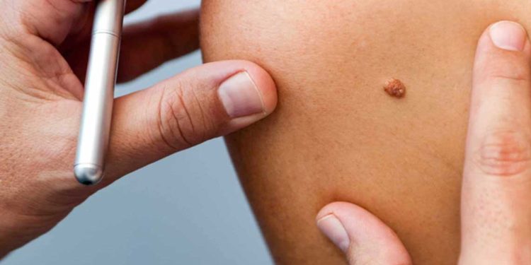 روسيا تستعد لإطلاق أول لقاح لعلاج السرطان خلال خريف 2025