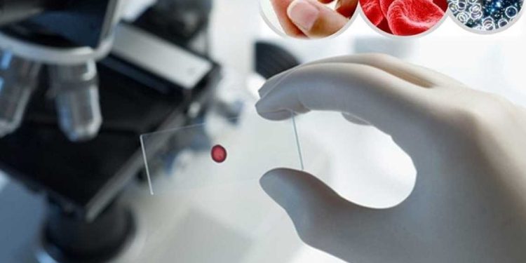 اختراق طبي…تحويل كلية من فصيلة دم A إلى O بنجاح