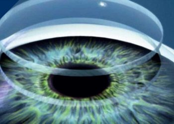 أول قرنية مطبوعة ثلاثيًا تستعيد البصر