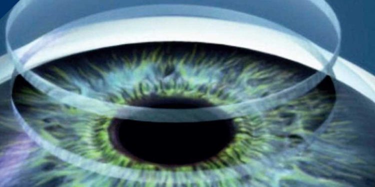 أول قرنية مطبوعة ثلاثيًا تستعيد البصر