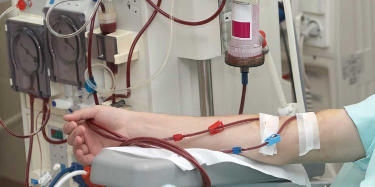 35 ألف مريض يخضعون لتصفية الدم عبر 420 مركزًا